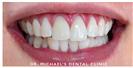 Teeth Whitening - Dr. Michael's Dental Clinics - سالة عيادة أسنان د. مايكل