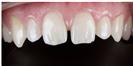 Dental Veneers - Dr. Michael's Dental Clinics - سالة عيادة أسنان د. مايكل