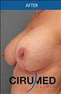 Breast Lift - عيادة سيركاميد