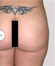 Brazilian Butt Lift - مركز إستيثيكا الطبي الجراحي