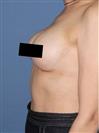 Breast Augmentation - مركز إستيثيكا الطبي الجراحي