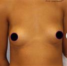 Breast Augmentation - مركز إستيثيكا الطبي الجراحي