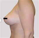 Breast Lift - مركز إستيثيكا الطبي الجراحي