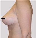 Breast Reduction - مركز إستيثيكا الطبي الجراحي