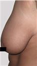 Breast Reduction - مركز إستيثيكا الطبي الجراحي