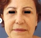 Eyelid Aesthetics (Blepharoplasty) - مركز إستيثيكا الطبي الجراحي