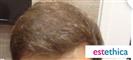 Hair Transplant - مركز إستيثيكا الطبي الجراحي