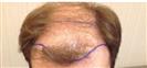 Hair Transplant - مركز إستيثيكا الطبي الجراحي