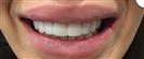 Teeth Whitening - مركز إستيثيكا الطبي الجراحي