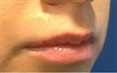 Lip Enhancement (Lip Augmentation) - مركز إستيثيكا الطبي الجراحي