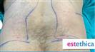 Liposuction (Abdominal) - مركز إستيثيكا الطبي الجراحي