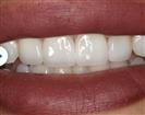 Teeth Cleaning - مركز إستيثيكا الطبي الجراحي