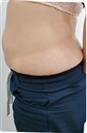 Abdominoplasty (Tummy Tuck) - مركز إستيثيكا الطبي الجراحي