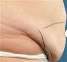 Tummy Tuck (Abdominoplasty) - مركز إستيثيكا الطبي الجراحي