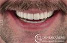 Tooth Extractions, Crown Length Extensions, Root Canal Treatment, Crowns: E-max and Zirconium Crowns - مركز دينت أكاديمي للرعاية الصحية للفم والأسنان