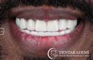 Tooth Extractions, Dental Implants, Root Canal Treatment, Smile Design with Crowns - مركز دينت أكاديمي للرعاية الصحية للفم والأسنان