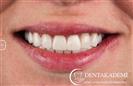 Root Canal Treatment, Smile Design with E-max Crowns - مركز دينت أكاديمي للرعاية الصحية للفم والأسنان
