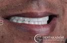 Dental Implants, Maxillofacial Surgery, Root Canal Treatment, Dental Crown: Zirconium Crowns - مركز دينت أكاديمي للرعاية الصحية للفم والأسنان