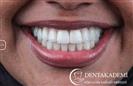 Root Canal Treatment, Laminate Veneers - مركز دينت أكاديمي للرعاية الصحية للفم والأسنان