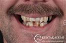 Tooth Extractions, Crown Length Extensions, Root Canal Treatment, Crowns: E-max and Zirconium Crowns - مركز دينت أكاديمي للرعاية الصحية للفم والأسنان