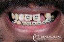 Tooth Extractions, Dental Implants, Root Canal Treatment, Smile Design with Crowns - مركز دينت أكاديمي للرعاية الصحية للفم والأسنان