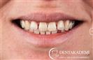 Root Canal Treatment, Smile Design with E-max Crowns - مركز دينت أكاديمي للرعاية الصحية للفم والأسنان