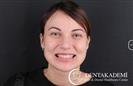 Zirconium Crowns - مركز دينت أكاديمي للرعاية الصحية للفم والأسنان