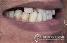 Dental Implants, Maxillofacial Surgery, Root Canal Treatment, Dental Crown: Zirconium Crowns - مركز دينت أكاديمي للرعاية الصحية للفم والأسنان