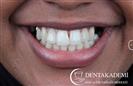 Root Canal Treatment, Laminate Veneers - مركز دينت أكاديمي للرعاية الصحية للفم والأسنان