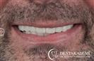 Tooth Extraction and Dental Implants: All-on-6 Implants & All-on-4 Implants - مركز دينت أكاديمي للرعاية الصحية للفم والأسنان