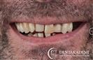 Tooth Extraction and Dental Implants: All-on-6 Implants & All-on-4 Implants - مركز دينت أكاديمي للرعاية الصحية للفم والأسنان