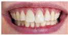 Teeth Whitening - Dr. Michael's Dental Clinics - سالة عيادة أسنان د. مايكل