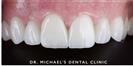 Dental Veneers - Dr. Michael's Dental Clinics - سالة عيادة أسنان د. مايكل
