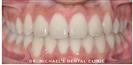 Dental Braces - Dr. Michael's Dental Clinics - سالة عيادة أسنان د. مايكل