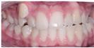 Dental Braces - Dr. Michael's Dental Clinics - سالة عيادة أسنان د. مايكل