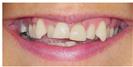 Braces and Veneers - Dr. Michael's Dental Clinics - سالة عيادة أسنان د. مايكل