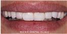 Dental Veneers - Micris Dental Clinics - عيادة ميكريس لطب الأسنان