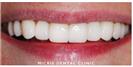 Dental Veneers - Micris Dental Clinics - عيادة ميكريس لطب الأسنان
