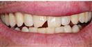 Dental Fillings - Micris Dental Clinics - عيادة ميكريس لطب الأسنان