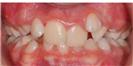 Dental Braces - Micris Dental Clinics - عيادة ميكريس لطب الأسنان