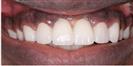 Zirconia Bridge - Micris Dental Clinics - عيادة ميكريس لطب الأسنان