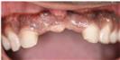 Zirconia Bridge - Micris Dental Clinics - عيادة ميكريس لطب الأسنان