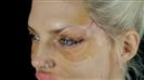 Eyelid Surgery - كيرا كلينك
