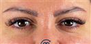 Eyelid Surgery - كيرا كلينك