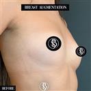 Breast Augmentation - عيادة الدكتور صالح أونور باسات
