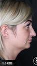Double Chin - Vaser Liposuction - Ultrasonic Rhinoplasty - عيادة الدكتور صالح أونور باسات