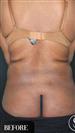 Tummy Tuck - Vaser Liposuction - J Plasma - عيادة الدكتور صالح أونور باسات