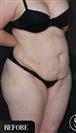 Tummy Tuck - Vaser Liposuction - عيادة الدكتور صالح أونور باسات
