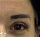Eyelid Surgery - مستشفى اداتيب  (ِADATIP)