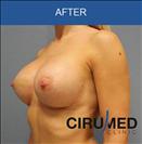 Breast Implants - عيادة سيركاميد